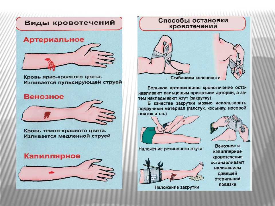 Помощь при кровотечении. виды кровотечений. кровоостанавливающие препараты
